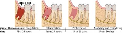 Pathogenesis and treatment of wound healing in patients with diabetes after tooth extraction